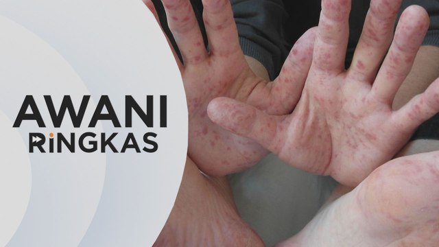 AWANI Ringkas: Kes HFMD di Terengganu meningkat lebih 700 peratus