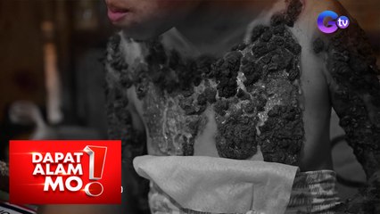 Dapat Alam Mo!: Ano ang panganib na dulot ng skin tubercolosis?