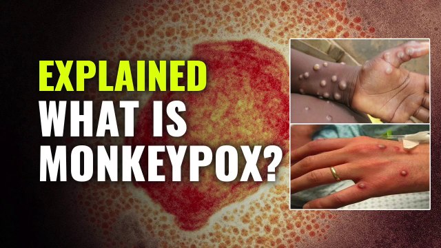 What Is Monkeypox? Symptoms Of Monkeypox Virus Infection- UK Reports A Confirmed Case