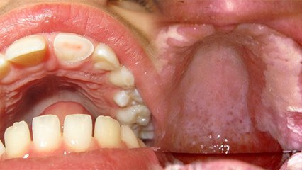 दांतों की कैविटी हो सकती है जानलेवा भूलकर भी न करें नजरअंदाज,जानें बचाव के उपाय । Boldsky