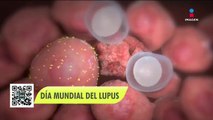 Lupus: tipos, síntomas y tratamiento