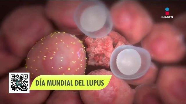 Lupus: tipos, síntomas y tratamiento