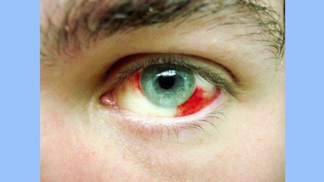 bd-derrames-en-los-ojos-100522