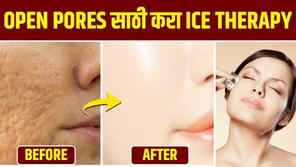 Descargar video: चेहऱ्यावरील ओपन पोर्सने त्रस्त आहात | How To Get Rid Open Pores On Face | Open Pores Treatment