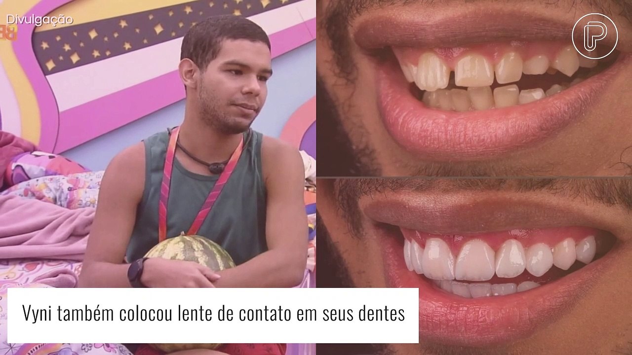 Antes e depois: harmonização facial, preenchimento labial e dentes novos! Veja transformação dos ex-'BBBs 22'