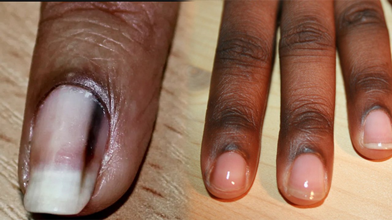 नाखून के आसपास का कालापन दूर करने का आसान तरीका,नाखून का कालापन दूर करने का तरीका । Boldsky