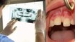 दांतों के बीच गैप Diastema बीमारी का कारण | दांतों के बीच गैप को कैसे ठीक करें | Boldsky