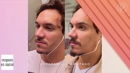 Antes e depois: Eliezer retoca harmonização facial de R$ 15 mil