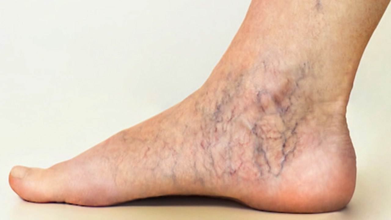 Arizona Vein and Laser Institute on the Symptoms of Peripheral Arterial Disease