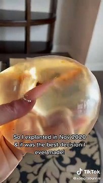 Influencer reveló que encontró moho en los implantes que le causaron serias enfermedades