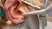 How 3 types of earwax are professionally deep cleaned