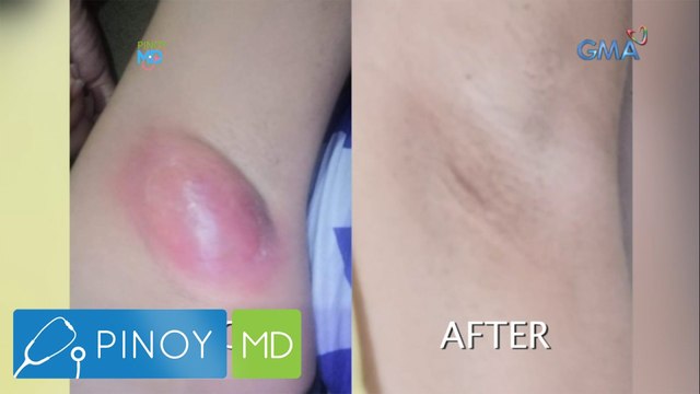 Babaeng tinubuan ng malaking pigsa sa kili-kili matapos subukan ang DIY wax, kumusta na? | Pinoy MD