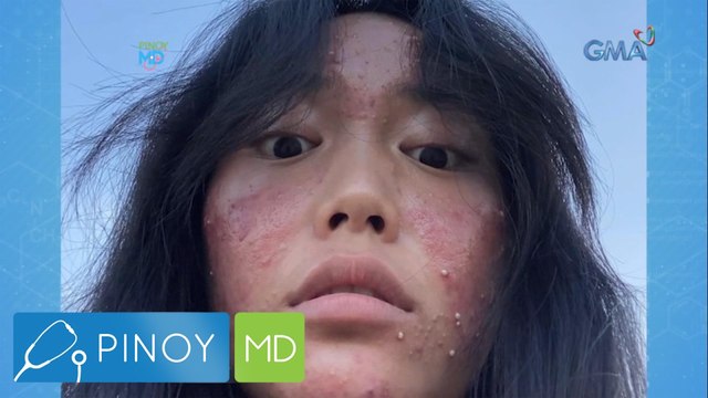 Cystic acne, paano kaya maiiwasan? | Pinoy MD