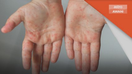 HFMD | Kes di Pahang meningkat enam kali ganda