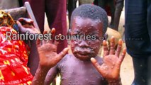 Monkey pox Virus