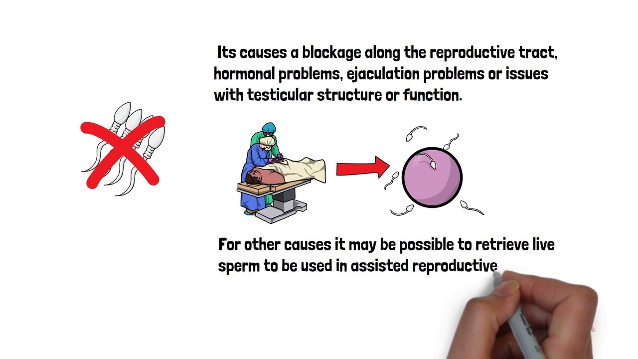 Azoospermia Male Fertility due to no sperm Causes & Treatment video Dailymotion