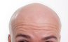 Calling a Man Bald Equates to Sexual Harassment, UK Judge Rules