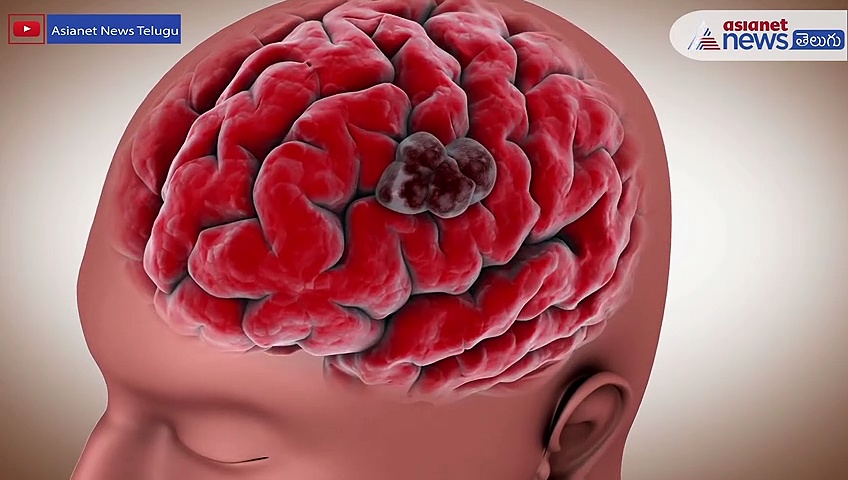 సాధారణ తలనొప్పికి, బ్రెయిన్ ట్యూమర్ వల్ల వచ్చే తలపోటుకి తేడాలేమిటి..?