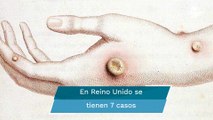 ¿Qué sabemos de la viruela del mono o viruela símica y qué tan peligrosa es?