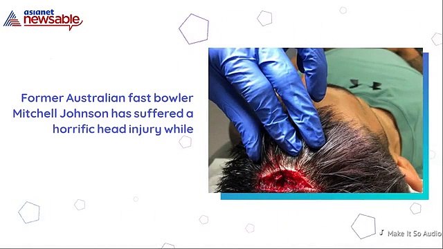 Australian cricket legend Mitchell Johnson suffers horrific head injury in gym
