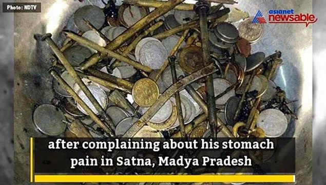 Doctor finds 100 nails, 263 coins and shaving blades in a man's stomach