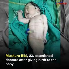 A mother surprised a medical team when she gave birth to a ‘mermaid’ baby in India