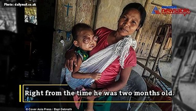 Two-year-old toddler with protruding eyes has finally found help through social media.