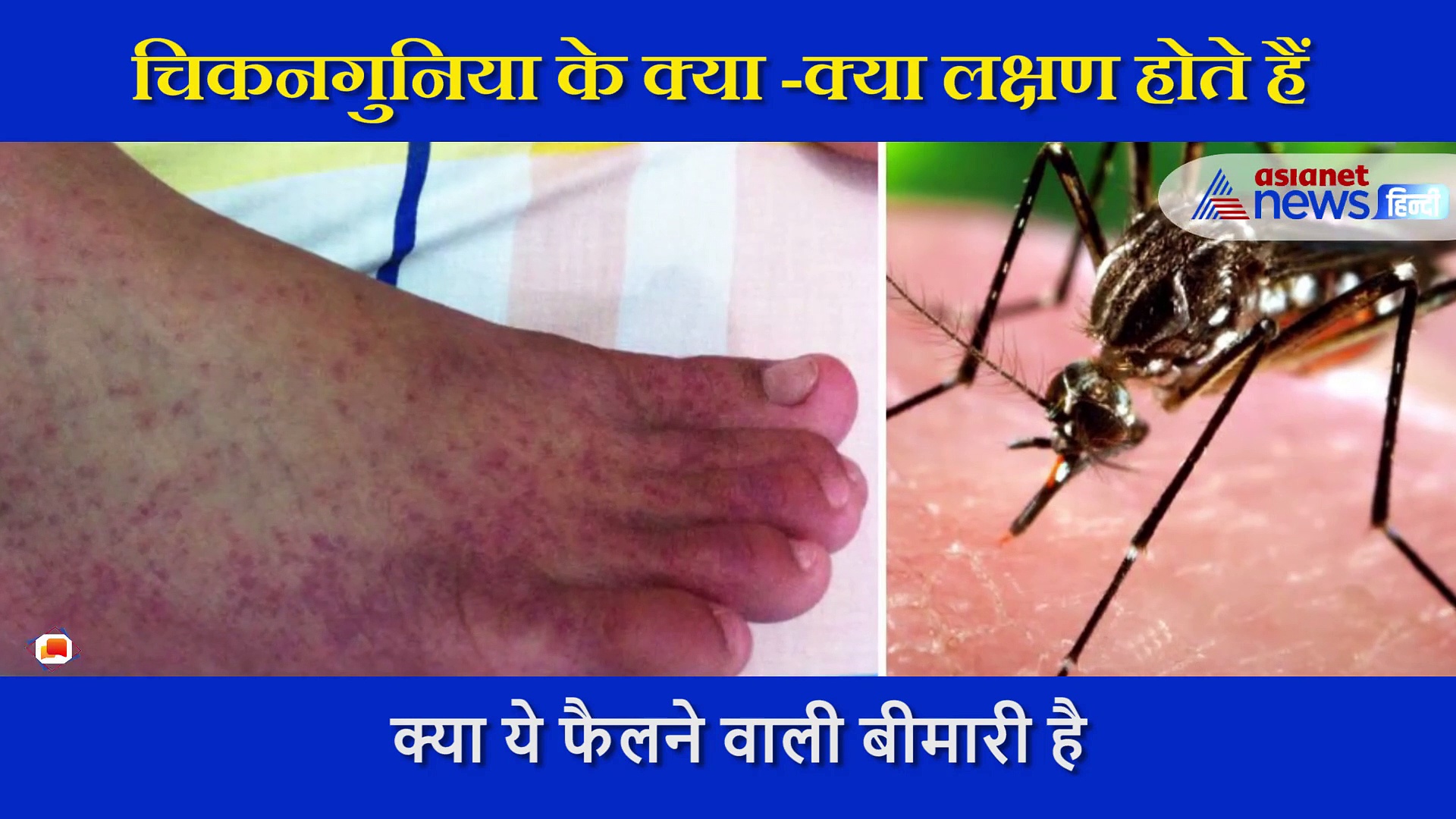 इन लक्षणों को न करें इग्नोर, हो सकती है चिकनगुनिया की गंभीर बीमारी