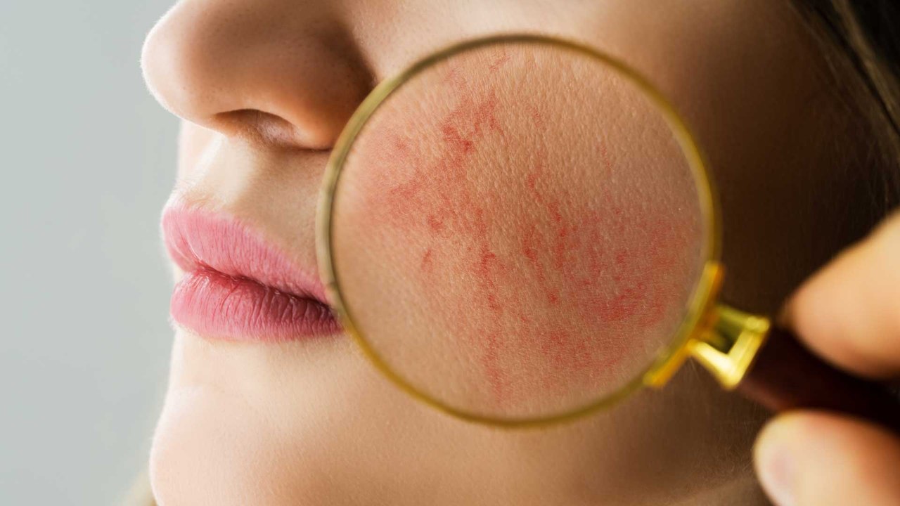 Rosacea: Was steckt hinter der Hautkrankheit?