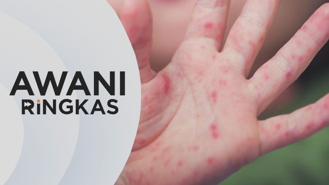AWANI Ringkas: Sabah catat peningkatan 51 kali ganda kes HFMD