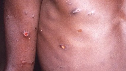 [오늘아침세계는] 코로나에 이어 이번에 '원숭이 두창' 불안 확산 / YTN