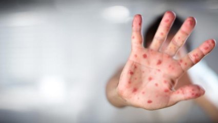 Kabusun yeni adı maymun çiçeği! Dalga dalga yayılan virüs bir ülkeye daha sıçradı