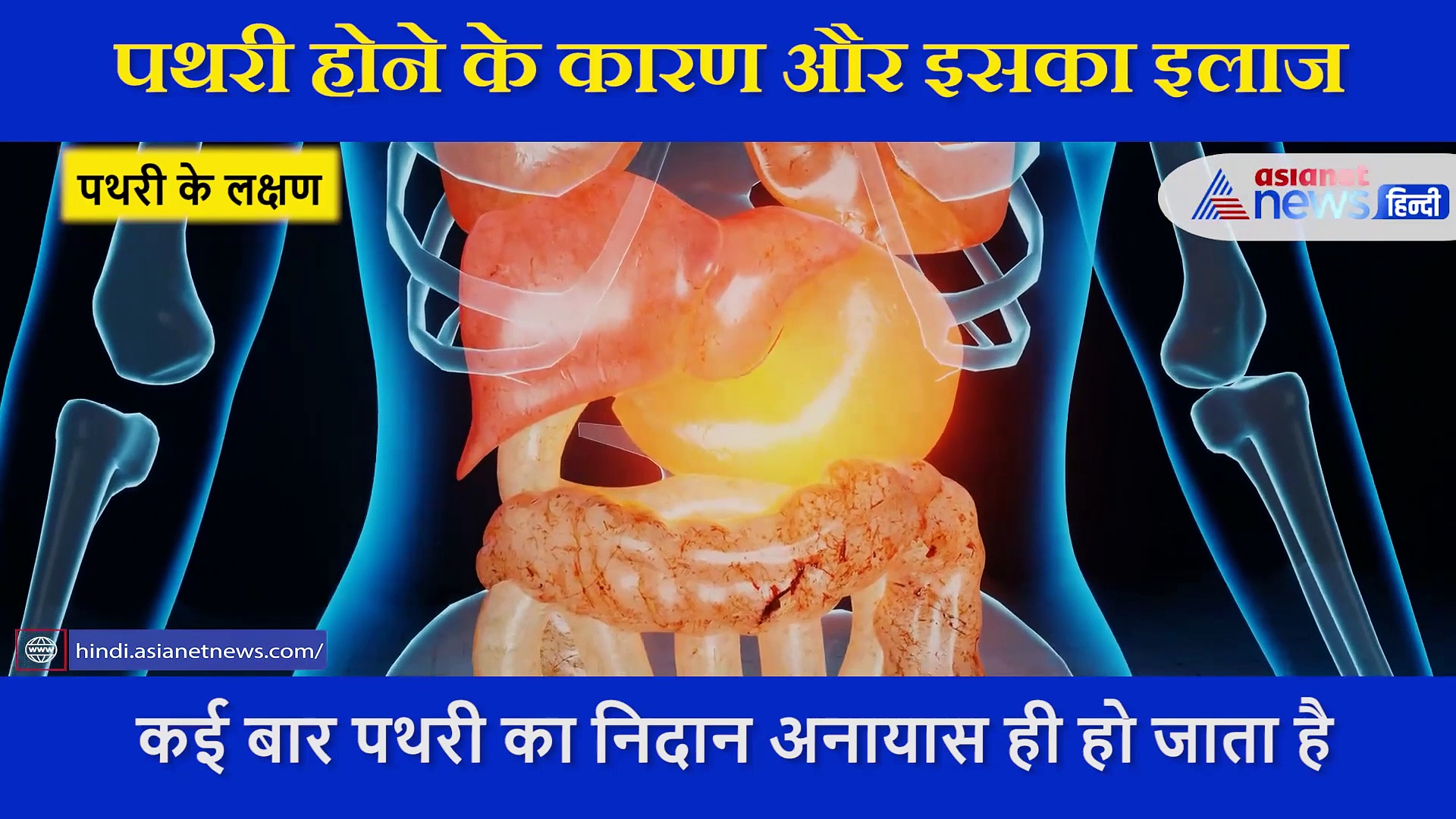 इन कारणों से होती है पथरी की बीमारी, एकसपर्ट से समझे इसे जड़ से खत्म करने का इलाज