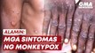 Mga sintomas ng monkeypox | GMA News Feed