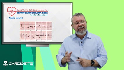 ECG NA SCA SEM SUPRA DE ST E QUESTÕES DE PROVA EM SCA
