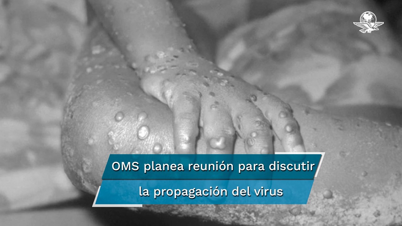 Francia y Alemania confirman primeros casos de viruela del mono y OMS convoca a expertos