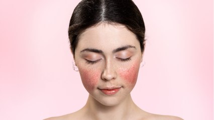 Rougeurs sur le visage : comment s'en débarrasser ?