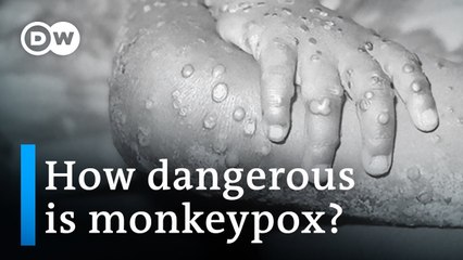 Concern grows as more countries detect monkeypox