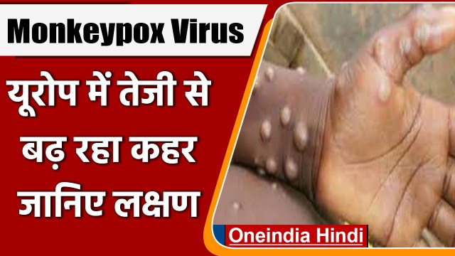 Monkeypox Virus: मंकीपॉक्स हुआ खतरनाक, Europe में तेजी से पैर पसार रहा, जानिए लक्षण | वनइंडिया हिंदी