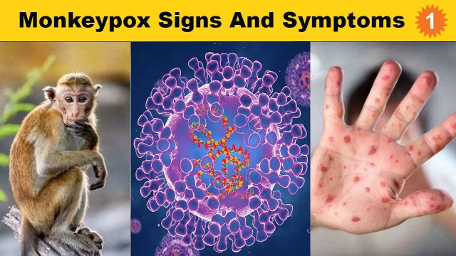 Monkeypox என்றால் என்ன? | Monkeypox Virus | Monkeypox Signs And Symptoms | Oneindia Tamil