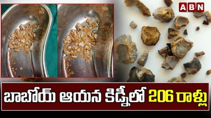 బాబోయ్‌ ఆయన కిడ్నీలో 206 రాళ్లు  | Kidney Stones | ABN Telugu
