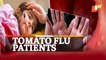 Tomato Flu: Bhubaneswar AIIMS Receiving Patients With Symptoms