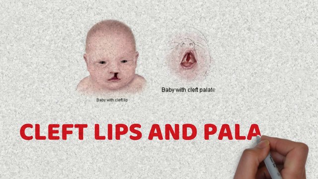Cleft lip and cleft palate (Facial and Oral Malformations)