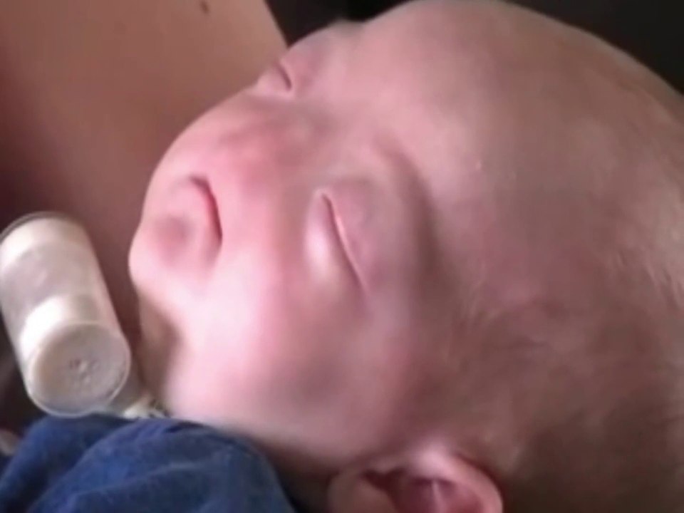 Eli Thompson - Born without a nose