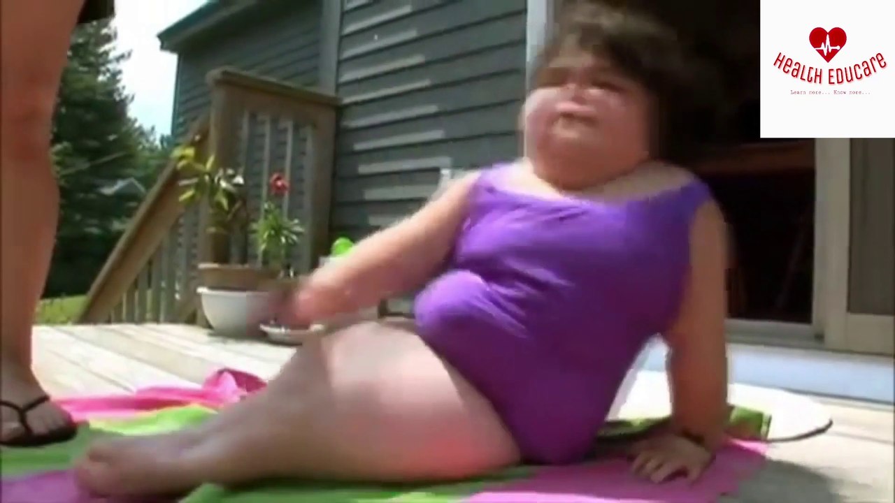 Mermmaid Syndrome - Sirenomelia