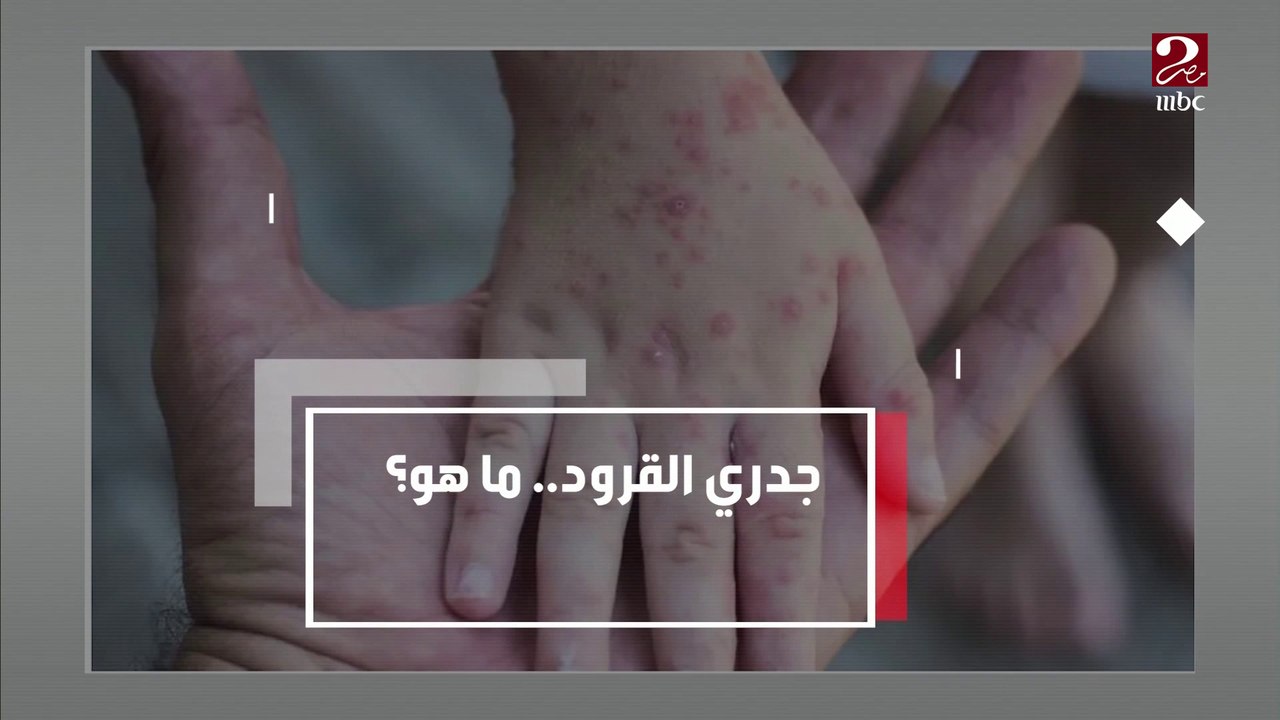 جدري القرود ..ما هو؟