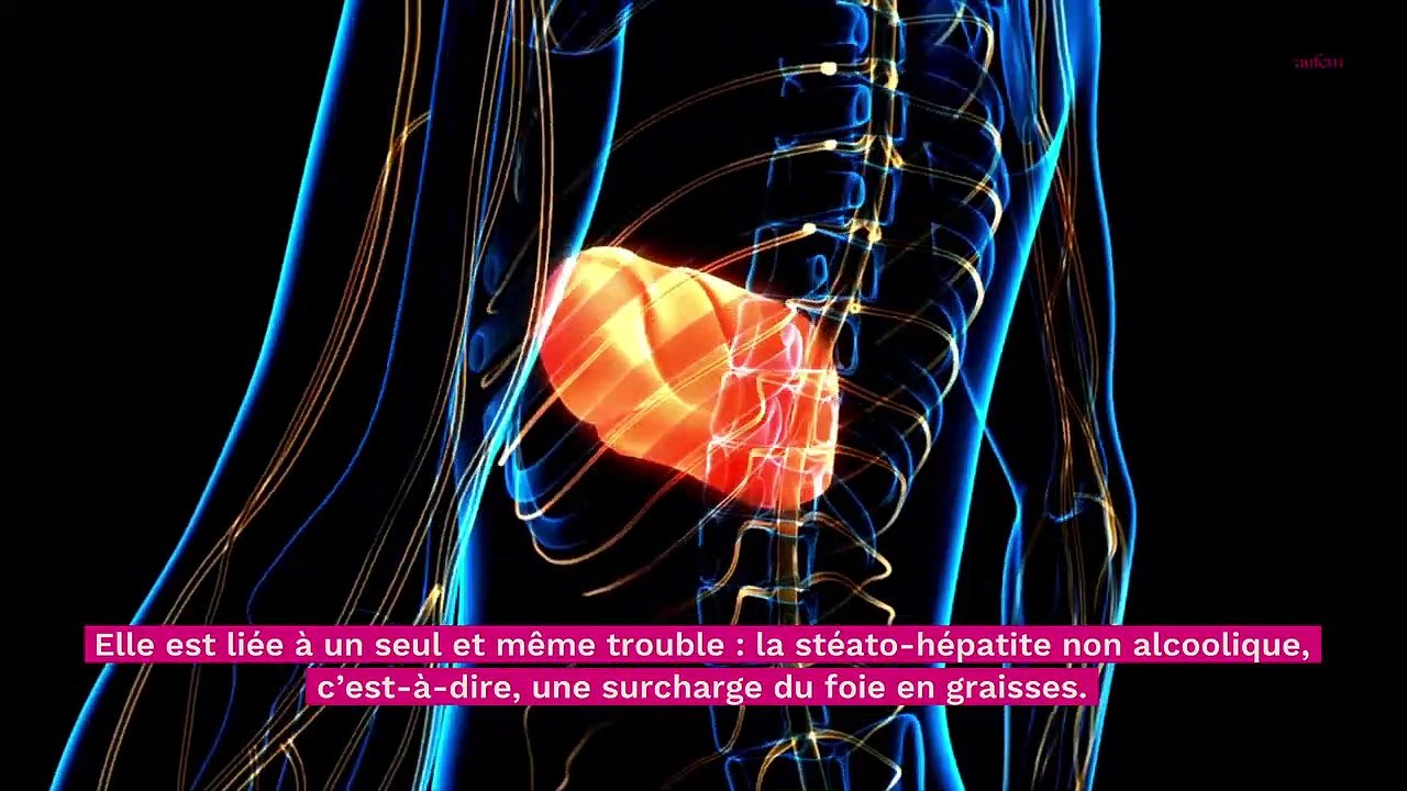 NASH : la maladie du soda, quels sont les symptômes ?