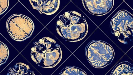 Enfermedad de Parkinson (Causas y Tratamiento)