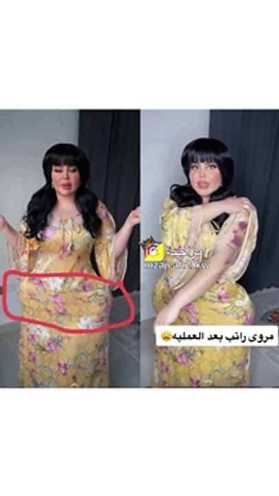 مروة راتب بكدمات وعلامات زرقاء في جسدها في أحدث ظهور