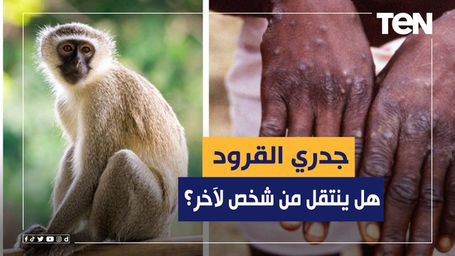 هل ينتقل جدري القرود من شخص لشخص آخر؟.. أستاذ أمرض باطنة يحذر